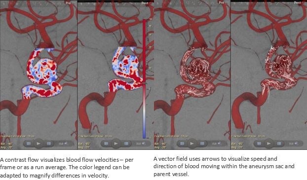 the contrast flow that visualizes blood flow velocities