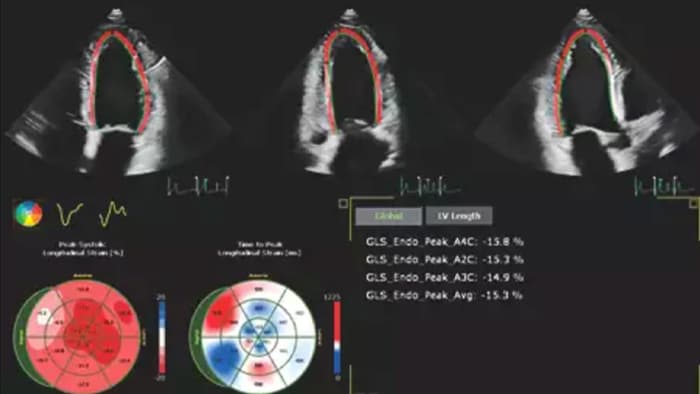 Image showing results of automation for robust, proven reproducible cardiac quantification in both 2D and 3D
