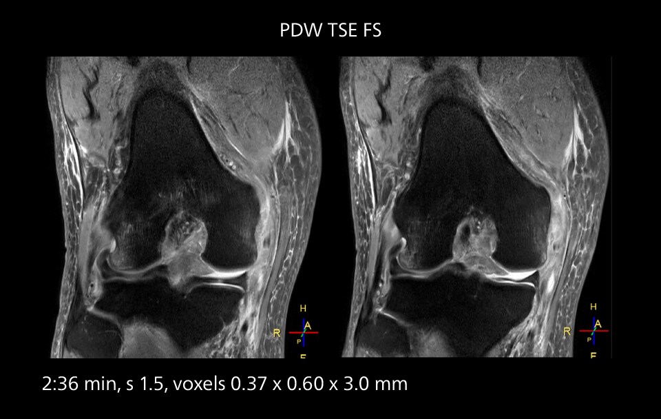 Knee mri scan four