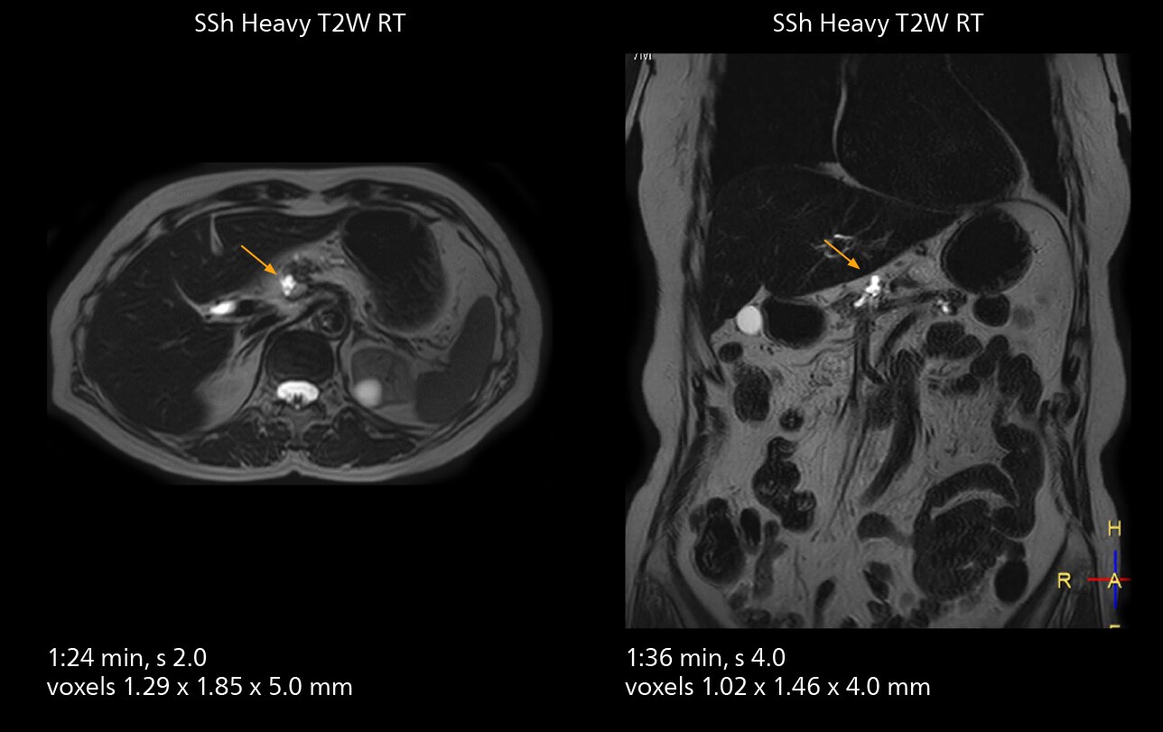 Mrcp mri two