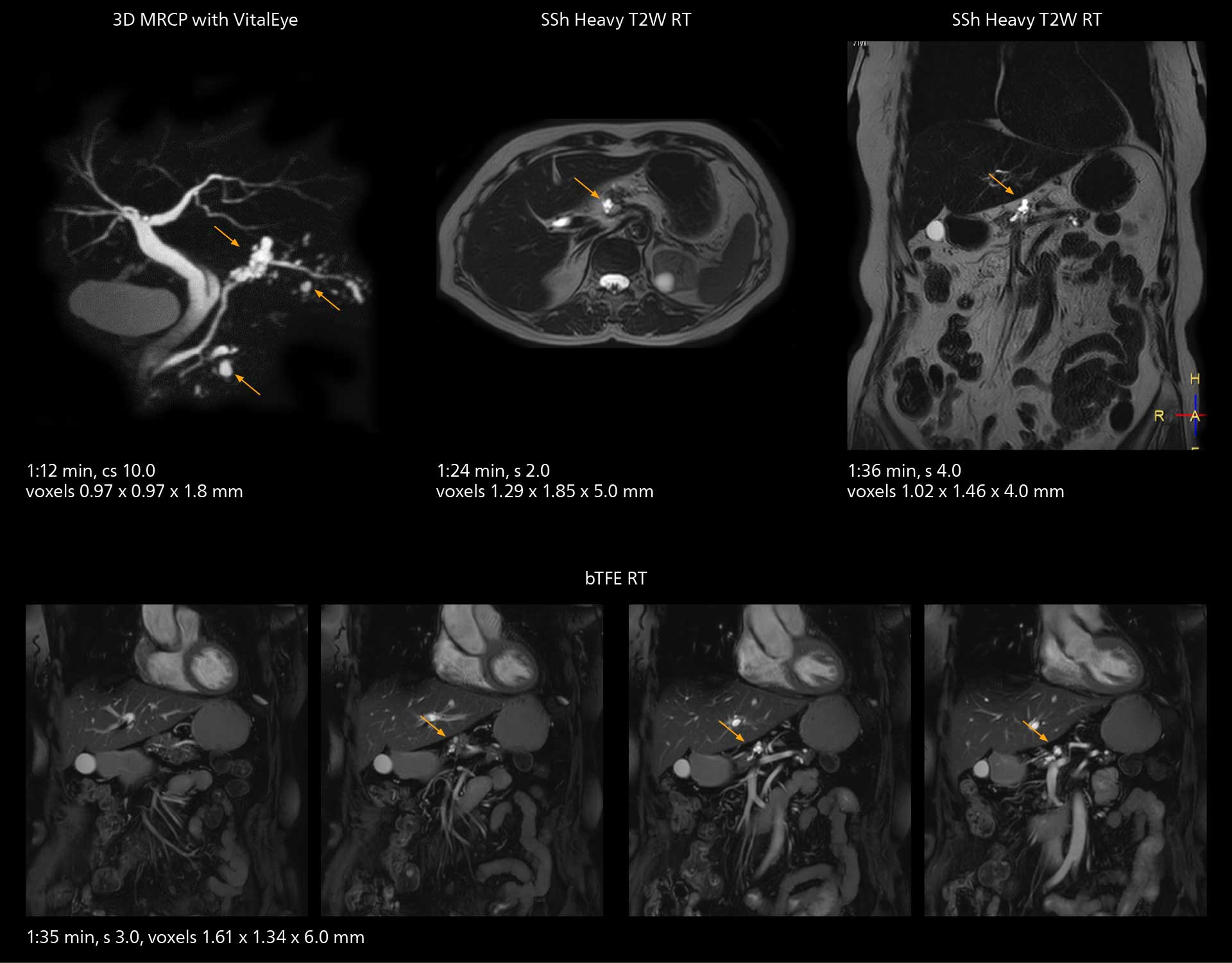 Mrcp mri 