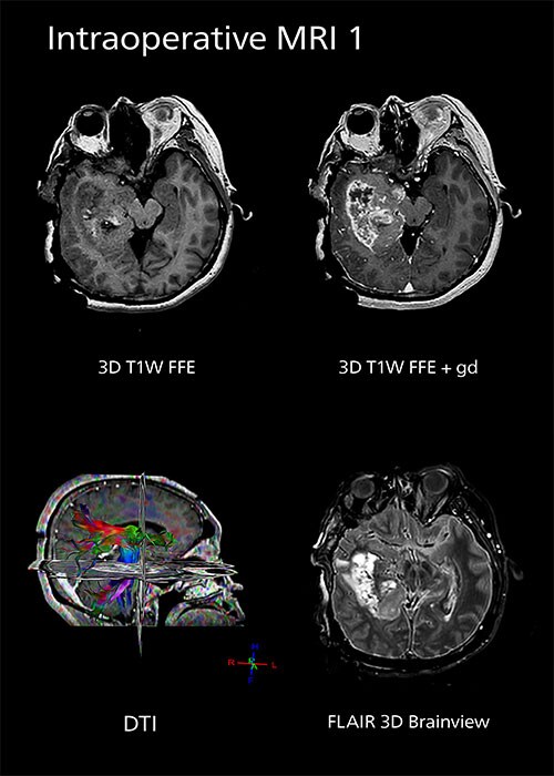 Intraoperative mri one