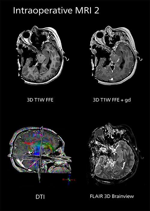 Intraoperative mri two