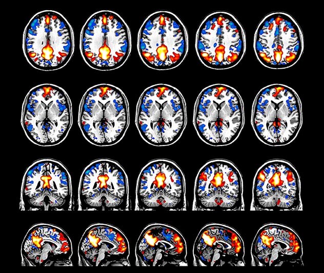 Multiband Sense Widens Possibilities Fmri Dmri Brain Fieldstrength Philips