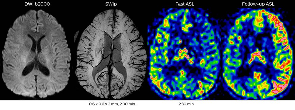 Acute right motor deficit and aphasia