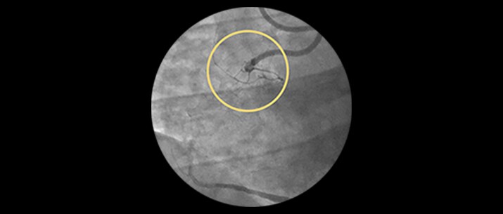 Chronic total occlusions