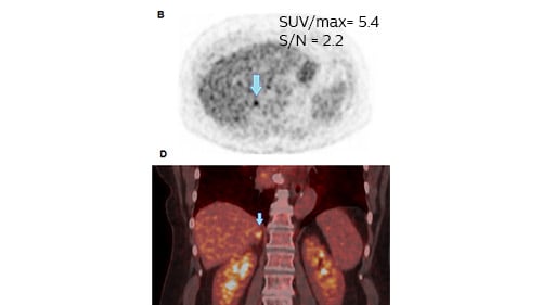 lung cancer image zwolle