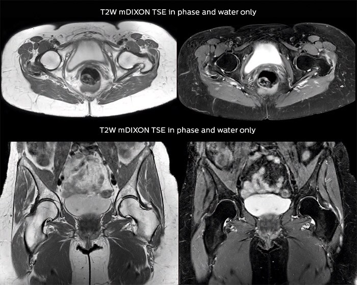 Lefebvre Case Hip MRI image