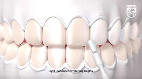 accelerated tooth whitening