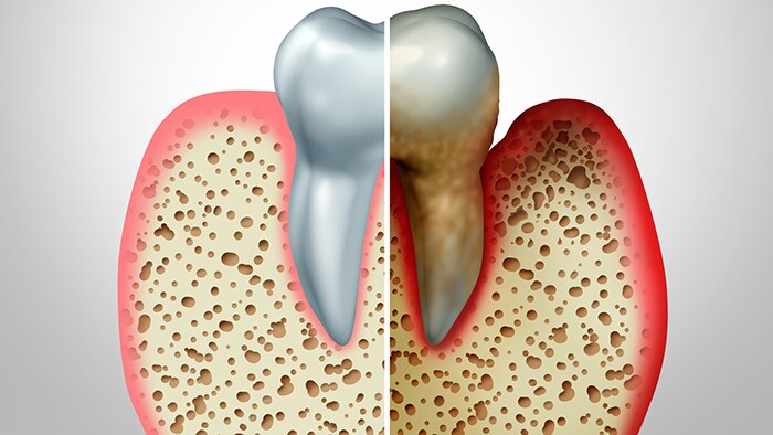 Stages of periodontitis