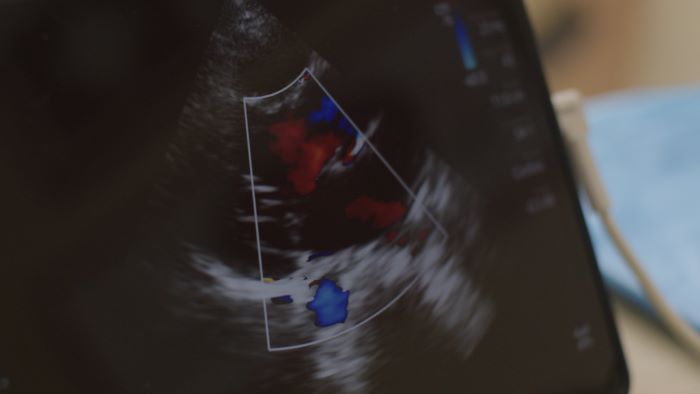 One to watch: An urgent call for early detection of rheumatic heart disease and more equitable cardiovascular care